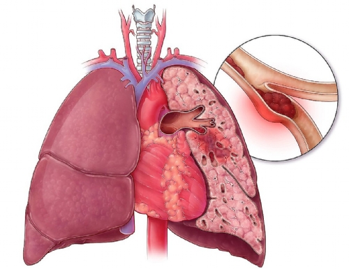 DIRETRIZES BRITÂNICAS PARA O MANEJO AMBULATORIAL DA EMBOLIA PULMONAR: FAÇA O DOWNLOAD DIRETRIZES BRITÂNICAS PARA O MANEJO AMBULATORIAL DA EMBOLIA PULMONAR: FAÇA O DOWNLOAD